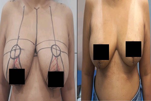 breasta3