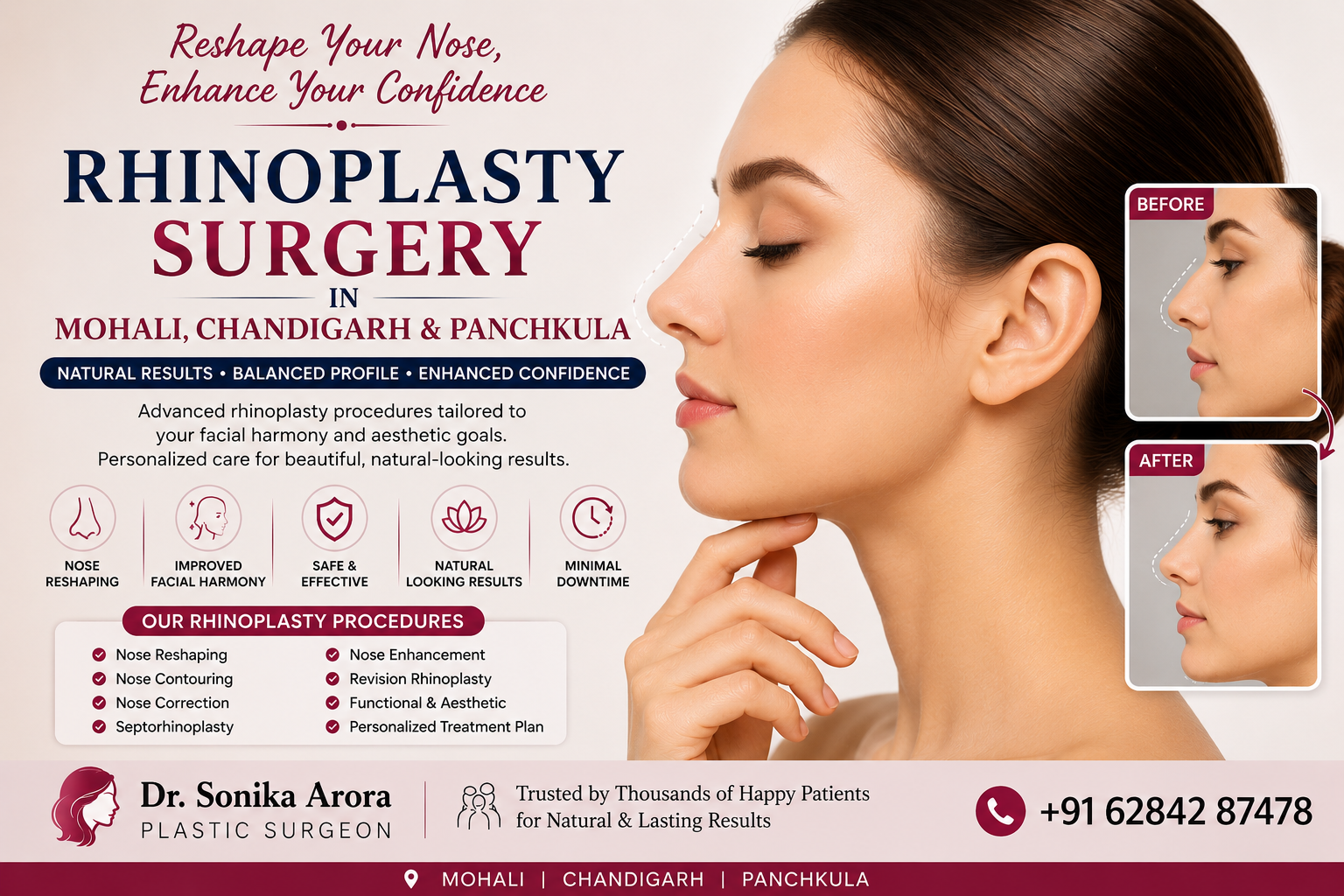 rhinoplasty surgery in mohali